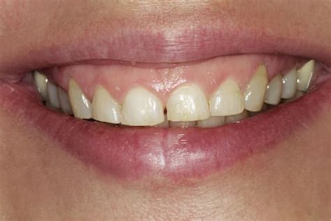 tiny teeth big gums